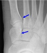 Lisfranc with arrows-1